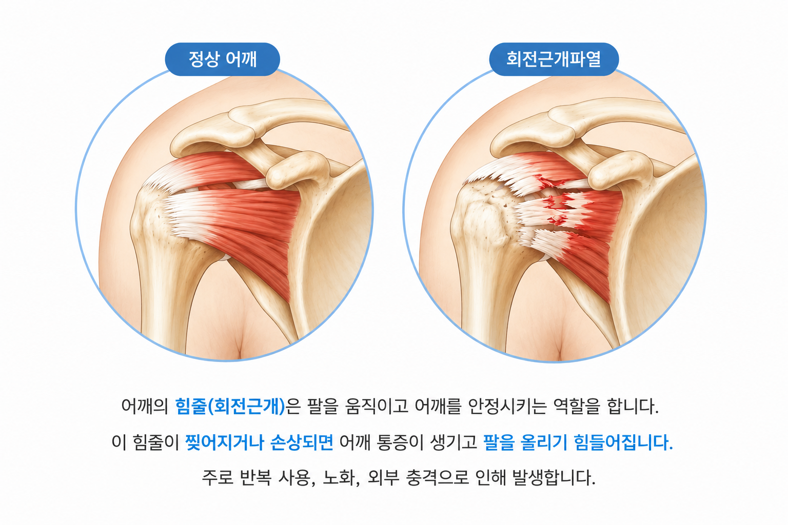 어깨통증 의료 일러스트