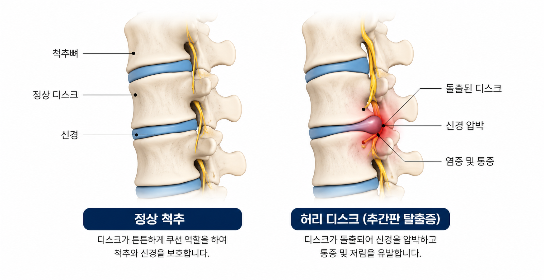 허리디스크 의료 일러스트
