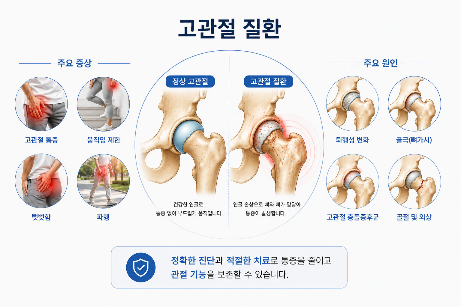 고관절질환 의료 일러스트