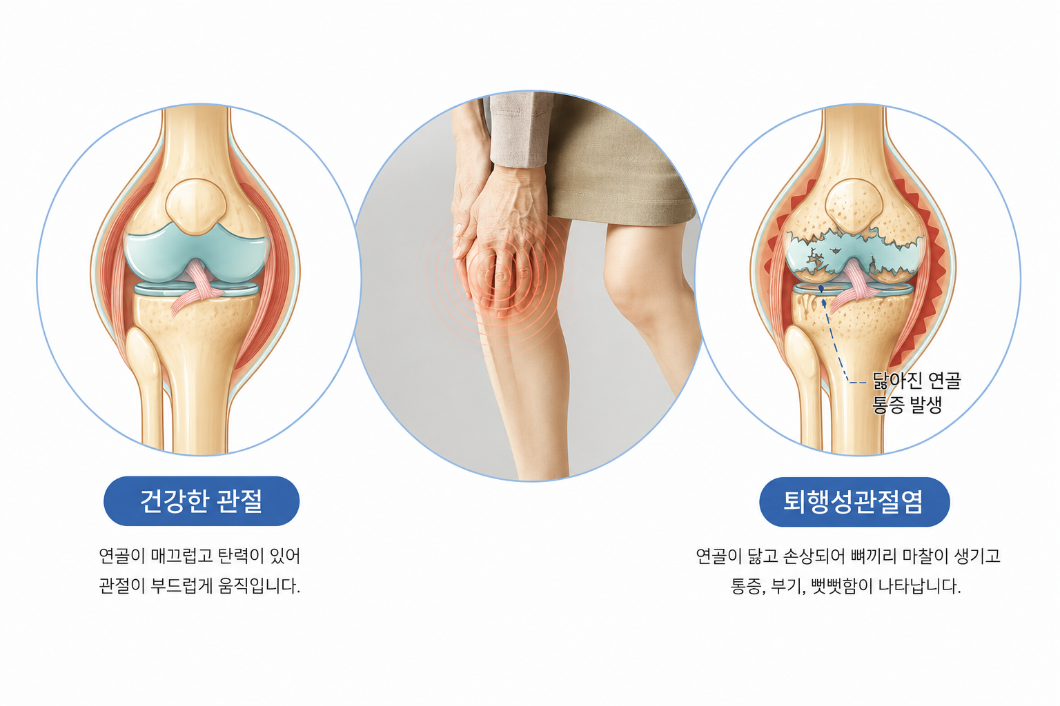 무릎통증 의료 일러스트