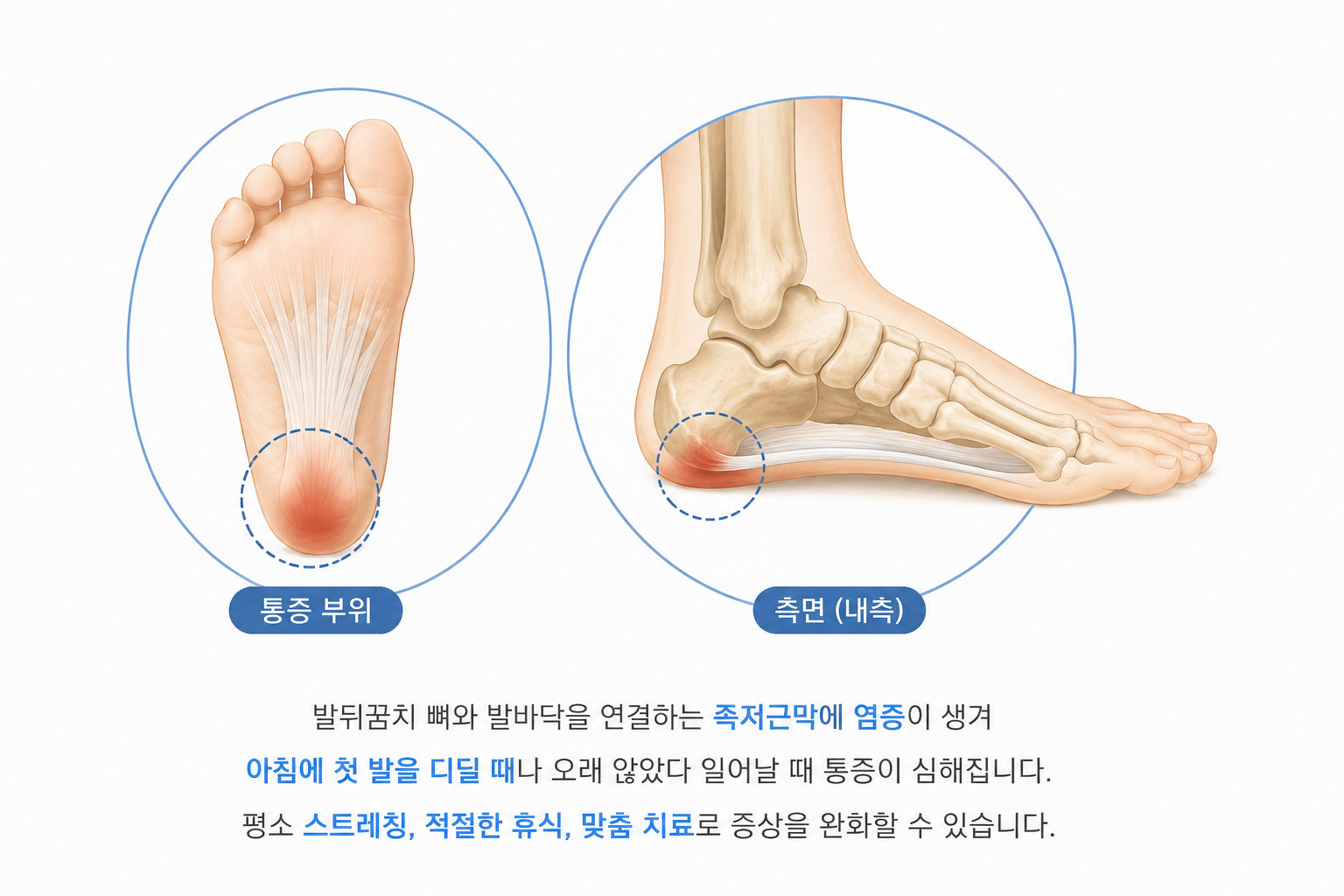 족부질환 의료 일러스트