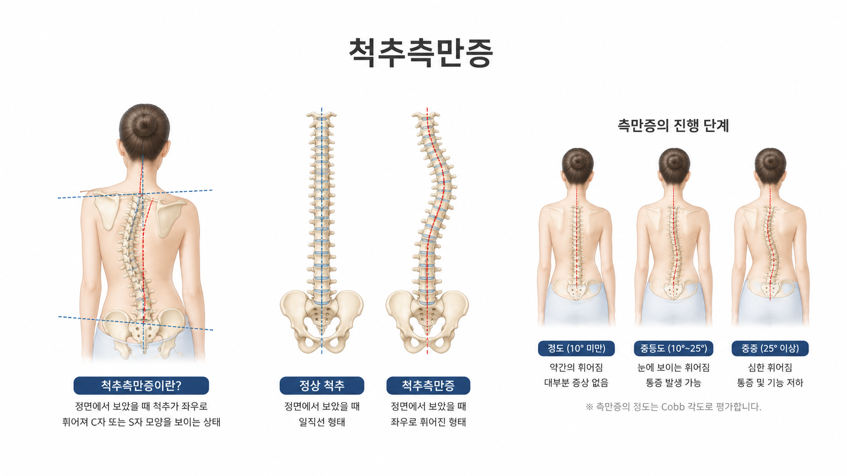척추측만증 의료 일러스트