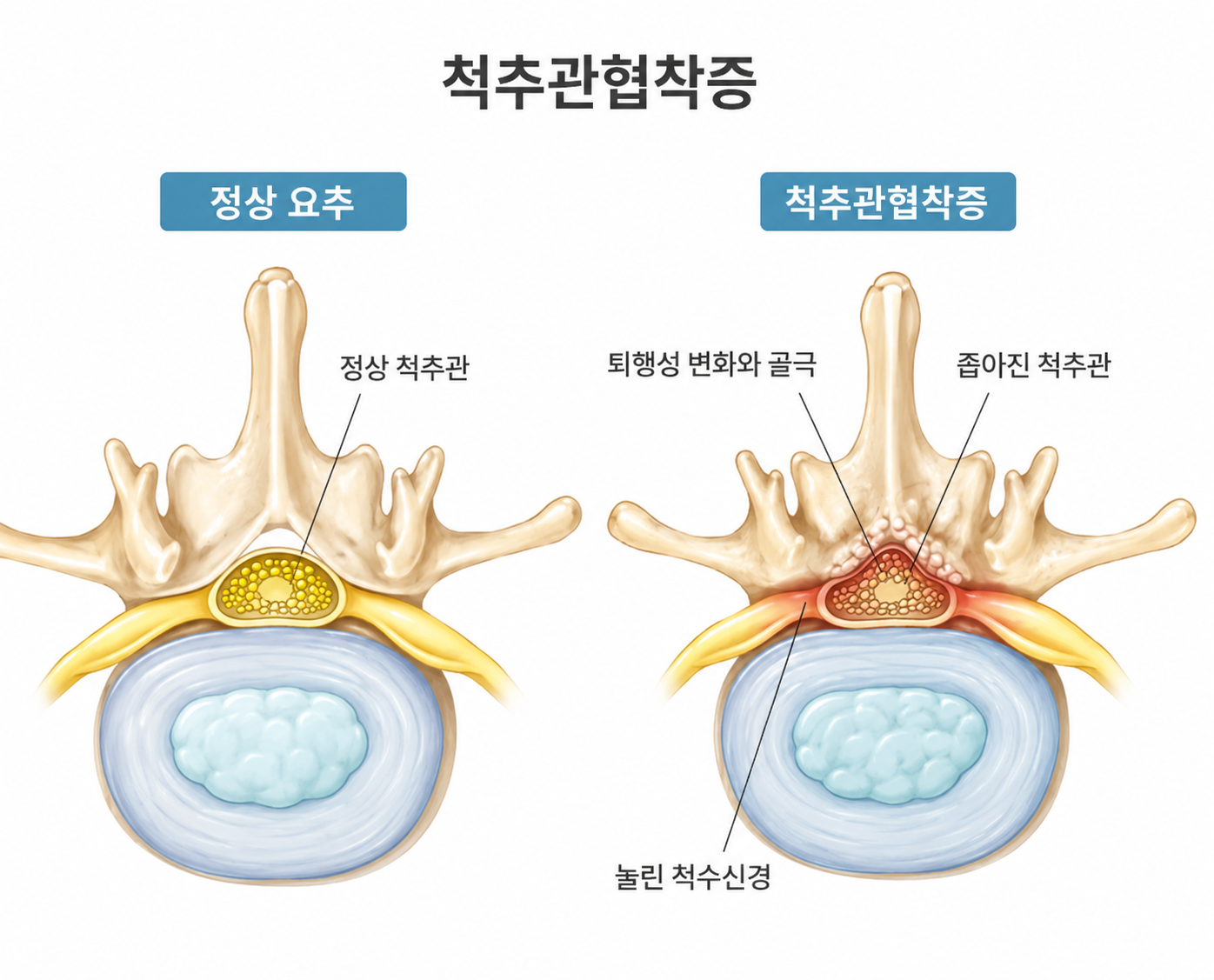 척추관협착증 의료 일러스트