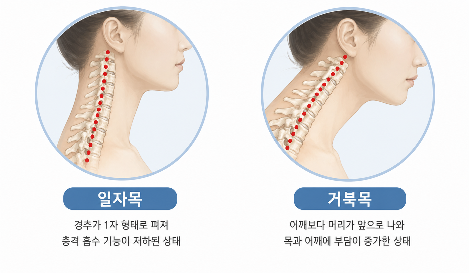 거북목·일자목 의료 일러스트