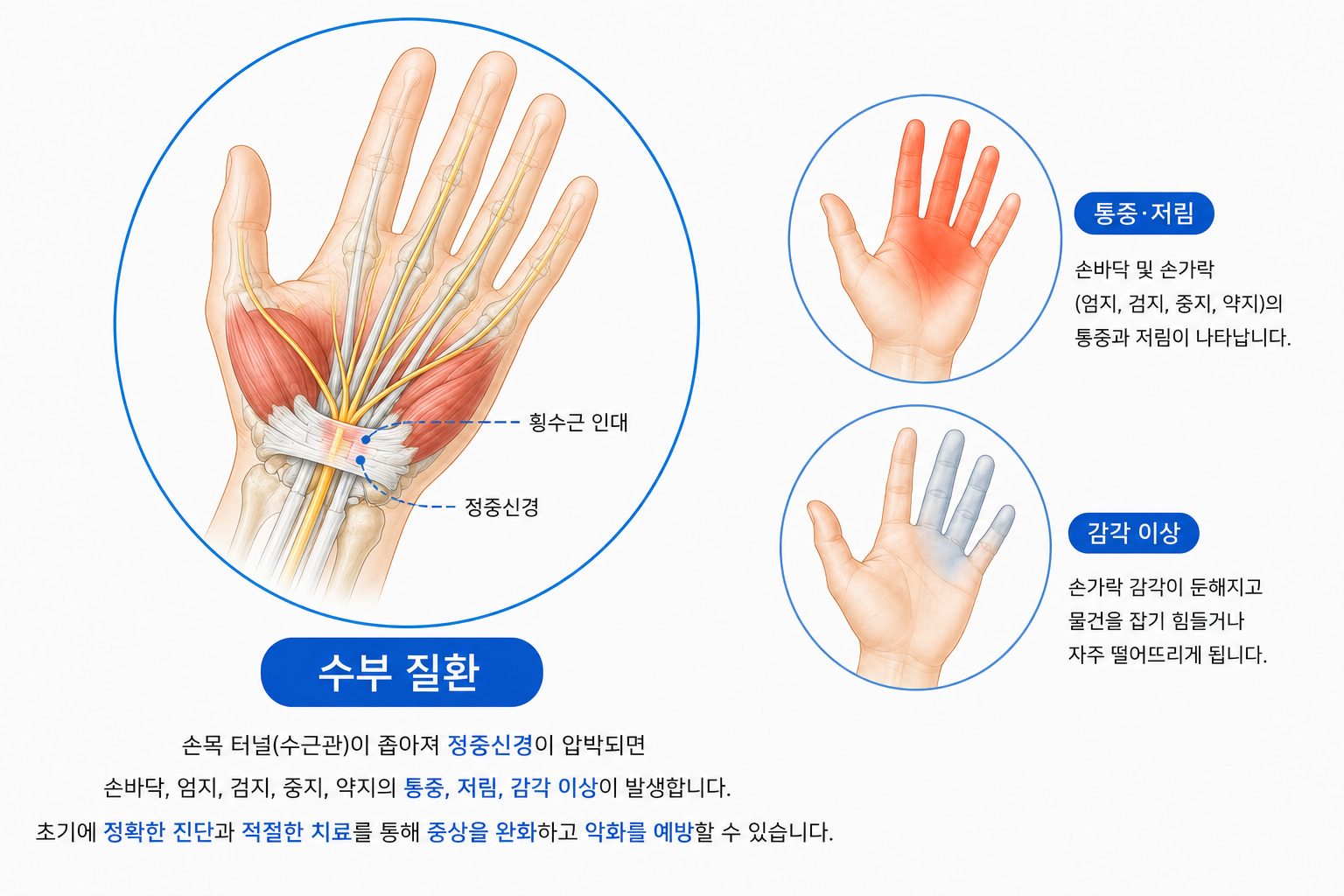 수부질환 의료 일러스트